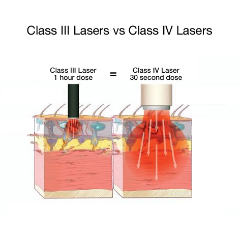 Diagram of laser penetrations class 3 and 4