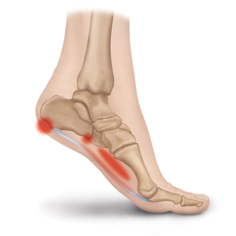 ultrasound and laser therapy for plantar fasciitis